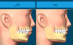تأثير تقويم الأسنان على شكل الوجه قبل وبعد العلاج