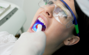 حشوات الأسنان التجميلية باستخدام ضوء المعالجة في العيادة
